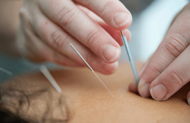 Image for Medical Acupuncture (Dry Needling) 